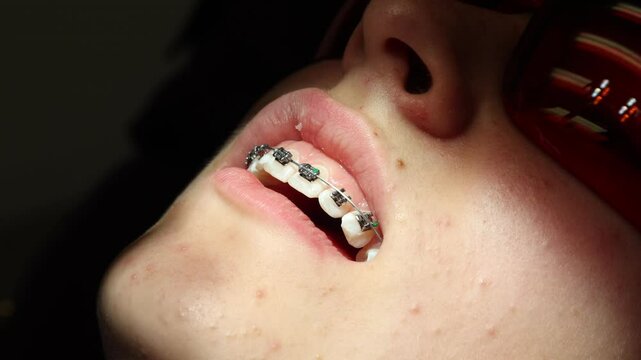 Orthodontist Adjusting Ceramic Braces on Patient Teeth, Close-up video of an orthodontist adjusting clear ceramic braces on a young patient's upper teeth during dental treatment. 