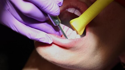 Dental Cleaning Procedure With Ultrasonic Scaler , Close-up video of a dental hygienist using an ultrasonic scaler to clean a patient's teeth during a routine dental check-up.  