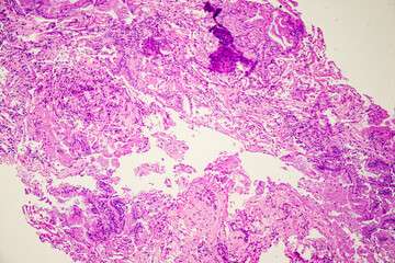 Medical themes: Microscopic image of mucinous adenocarcinoma of the lung.
