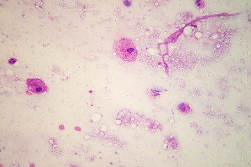 Medical themes: Microscopic image of mucinous adenocarcinoma of the lung.