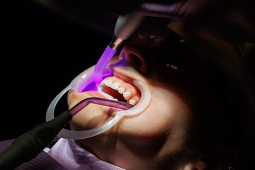 UV Light Curing Braces Adhesive in Dental Clinic, Close-up video of orthodontic UV light being used...