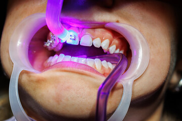 UV Light Curing Braces Adhesive in Dental Clinic, Close-up , of orthodontic UV light being used to...