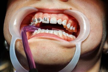 Close-Up of Braces Installation on Upper Teeth,Orthodontic treatment in progress showing close-up...