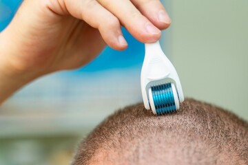 Man with early-stage baldness using a microneedling roller with sharp needles for scalp massage and...