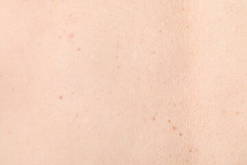 Woman with moles on her body, closeup