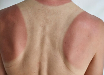 Sunburn on skin with distinct lines showing tan lines from swimwear and sun exposure