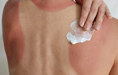 Applying soothing cream to sunburned skin after a day at the beach during summer concept