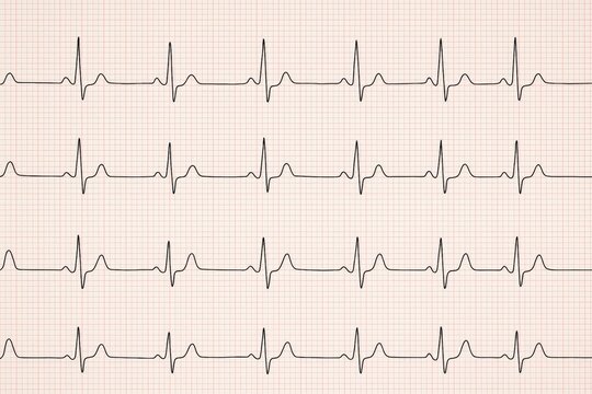 The ECG results are displayed on the paper