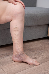 Women's legs with varicose veins
