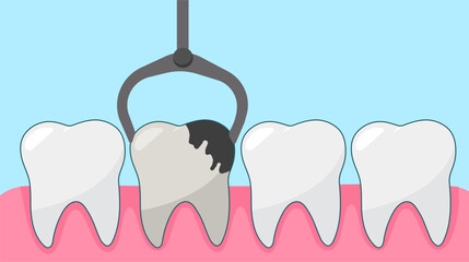 Tooth extraction by dental forceps oral health and dental care vector illustration