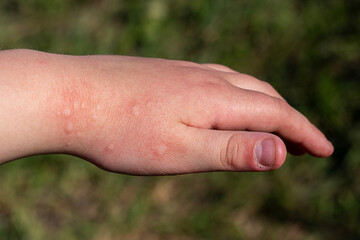 Close-up of a hand with skin irritation outdoors on a sunny day