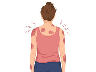 Woman with bun hairstyle is shown from back, wearing pink tank top and blue pants. Her arms and shoulders are covered with red, circular rashes, indicating skin condition