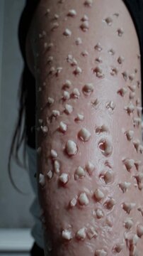 Trypophobic skin on female arm with lost of cluster holes in teeth in them.