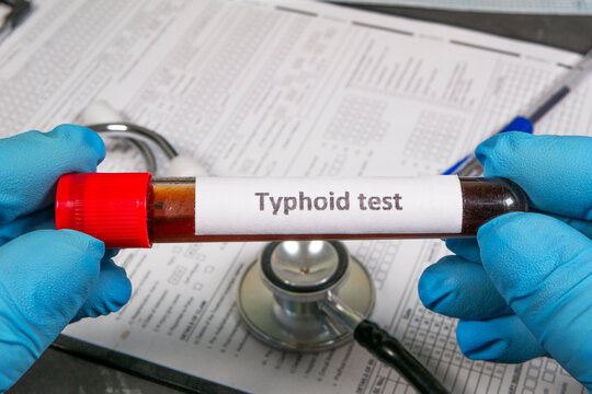 Doctor holding blood sample for typhoid test in laboratory