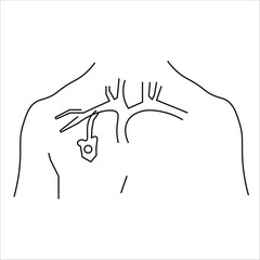 Port injection system. sewn into the skin