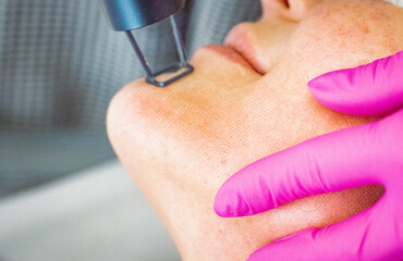 la piel de mujer aplicaciones láser Nd:YAG (ZYE Laser