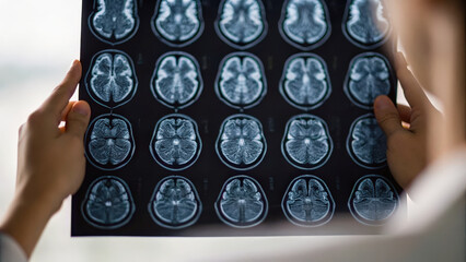 Brain stroke scan Brain scans reveal critical insights into stroke conditions, showcasing importance of timely diagnosis and treatment