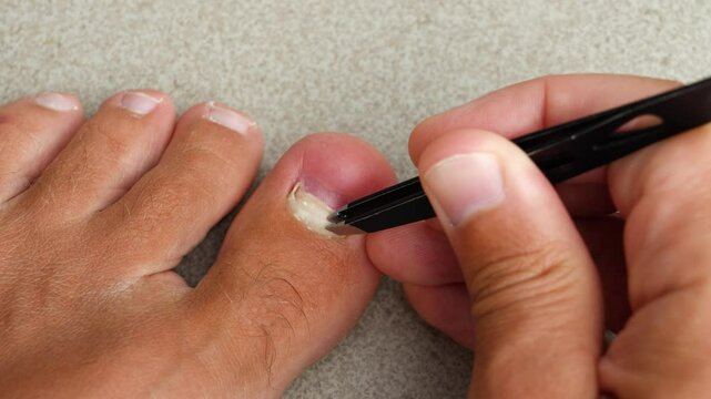 Removing an injured nail on the little finger with tweezers. Removed old fallen off nail big toe nail after mechanical injury damage under the nail, subnail
