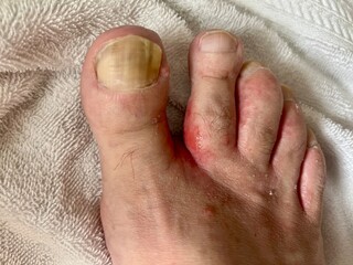 Close-up of foot showing thick, yellowed toenails with visible fungal infection and redness from...