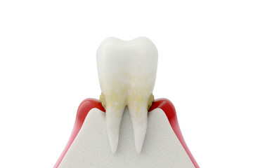 Periodontitis with Heavy Tartar Buildup and Gum Recession. Gum Disease Progression 3D Explainer.