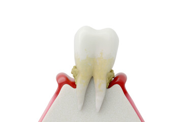 Advanced Periodontitis with Severe Bone Loss and Loose Tooth. Final Stage of Gum Disease 3D Render.