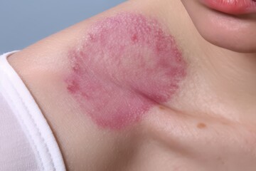Photo of a Red Circular Skin Patch on a Person's Shoulder - Skin Condition, Medical Image