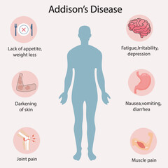 Flat vector illustration of Addison’s disease showing symptoms like fatigue, dark skin, depression, nausea, joint pain. Similar to adrenal insufficiency and hypothyroidism.