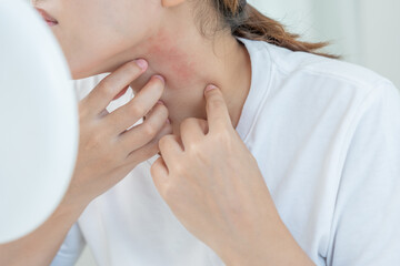 skin problem and beauty. Young woman scratch body has itchy skin from skin allergic, steroid...