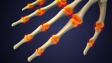 Inflamed Joints and Swelling from Rheumatoid Arthritis