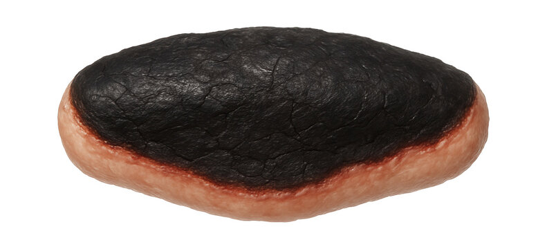 Eschar tissue with leathery, blackened crust and demarcated boundary