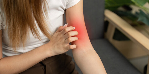 Skin Irritation. Young woman applying cream to her irritated arm.