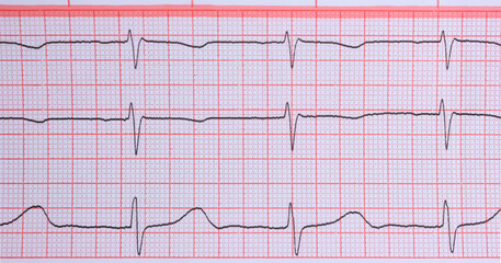 Electrocardiogram graph displaying heartbeats on grid paper.