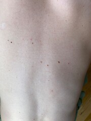 Human back with multiple moles and freckles. Natural skin texture with various pigmented spots,...