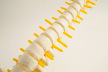 Spinal nerve and bone, Lumbar spine displaced herniated disc fragment, Model for treatment medical...