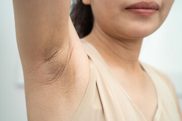 Asian woman have problem black armpit beauty skin care.