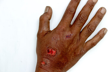 Examining Injured Hand with Skin Abrasions and Trauma