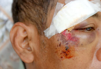 Facial Injury Requiring First Aid Bandage Near Eye