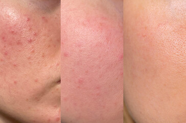 Fototapeta premium Detailed macro showing facial acne, redness, texture, and skin improvement after treatment. Perfect for dermatology, skincare, and beauty education visuals.