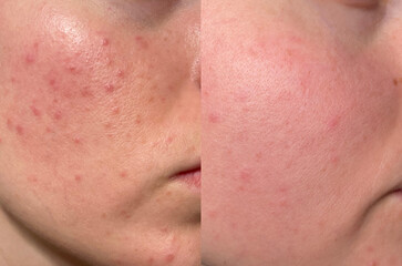 Macro before-and-after acne skin treatment photo with redness, blemishes, and pore detail. Ideal...