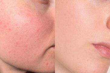 Close-up comparison of facial skin before and after acne treatment, showing redness, texture, and...