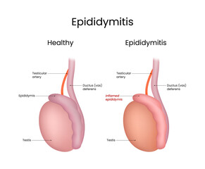 Comparison of Healthy Testicle and Testicle with Epididymitis