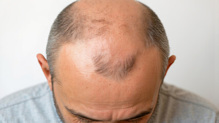 Fototapeta premium Detailed bald spot on middle-aged man, suitable for medical or cosmetic themes