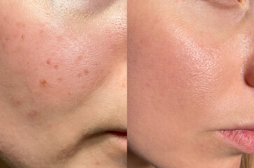 Close-up skin comparison showing acne scars, enlarged pores, and smoother results after treatment....