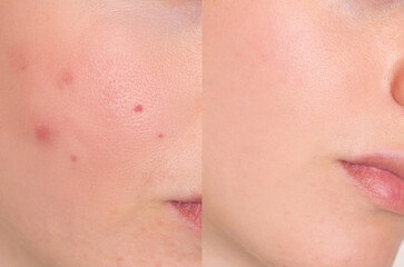 Close-up face showing acne, pimples, and smooth skin after skincare treatment. Ideal for...