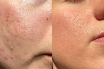 Close-up showing severe acne, pores, and smoother healthy skin after treatment. Perfect for...