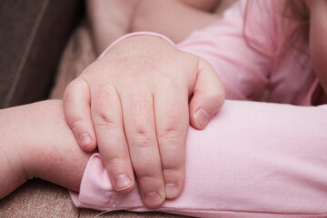 children's hands covered with atopic dermatitis, allergy on the skin of a child, redness on the skin