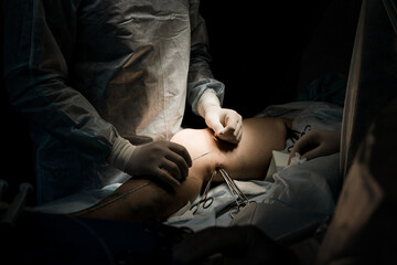 Endovenous laser procedure for chronic vein insufficiency. Medical staff treating leg varicose...
