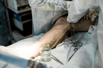 Close-up of EVLA catheter inserted into varicose vein. Laser vein ablation procedure performed in...