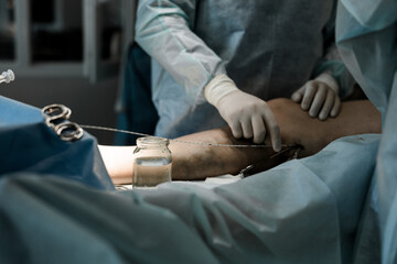 Endovenous laser therapy guided by duplex ultrasound. Vein specialist monitors catheter position...