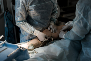 Laser catheter inside the vein beneath skin surface. EVLA in progress under sterile conditions,...